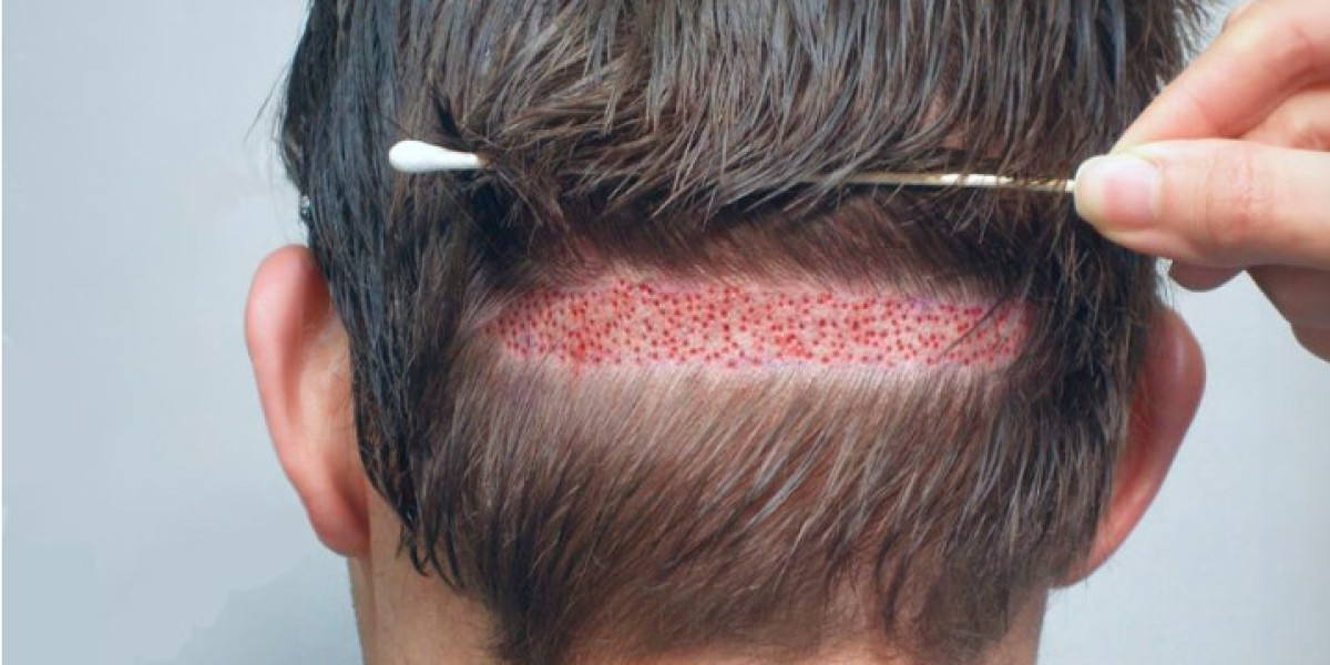 10 Things to Know Before Getting a Hair Transplant in Pakistan