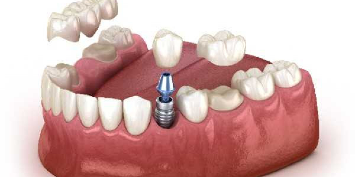 Same Day Dental Implants for Busy Professionals: Why It’s a Game-Changer