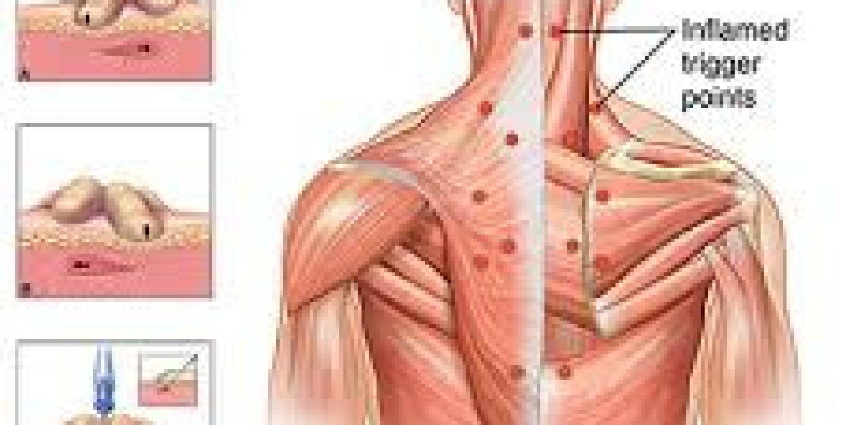 Trigger Point Injections in NYC: Effective Relief for Muscle Pain