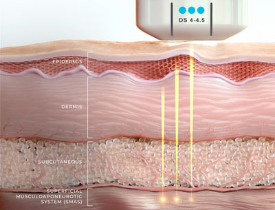 What to Know Before Trying Ultherapy Prime in Singapore - blogrify.com
