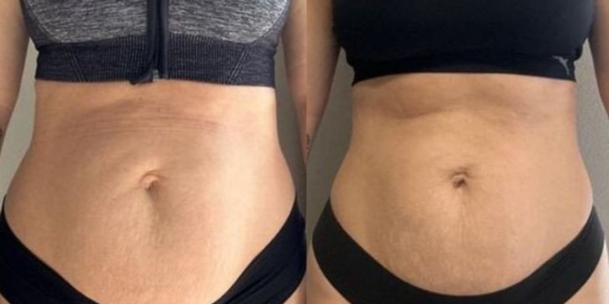 Liposuction in Islamabad – Reshape Your Body with Expert Care