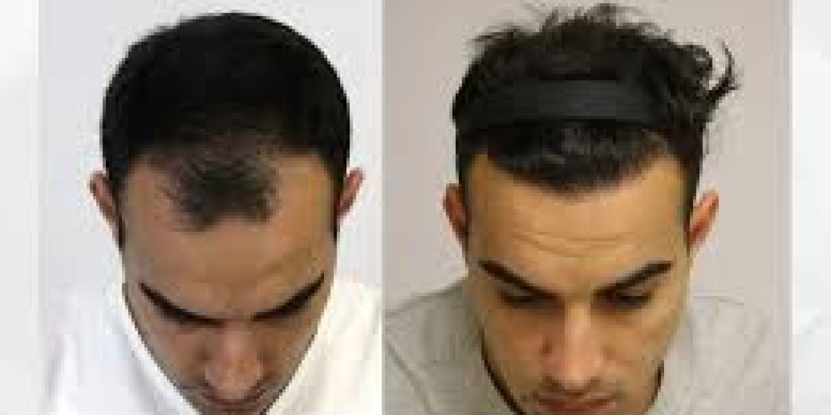 Hair Loss Solutions That Deliver Real Results: A Complete Guide to Modern Hair Transplant Care in Los Angeles