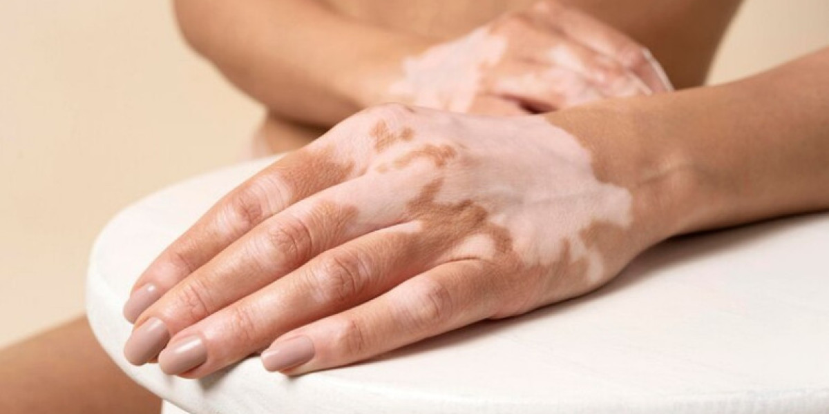 Homeopathy for Vitiligo Patients With Multiple Autoimmune Conditions