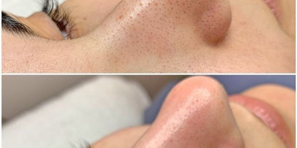 Hydrafacial in Islamabad: Restore Your Skin’s Natural Glow