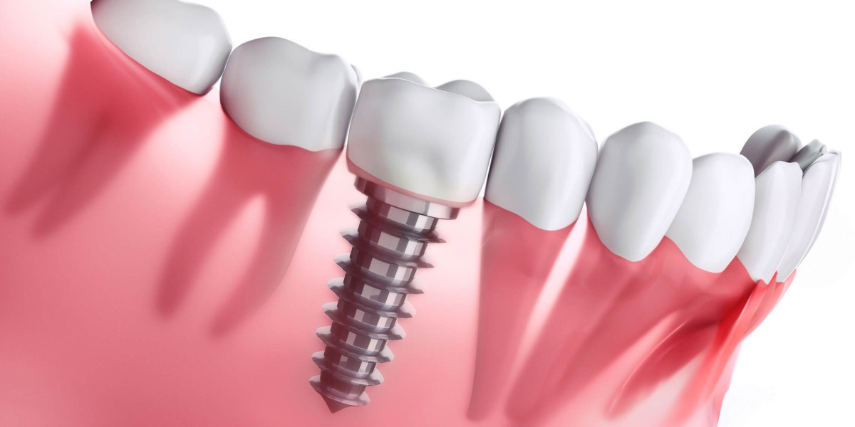 The Recovery Process After Getting Dental Implants
