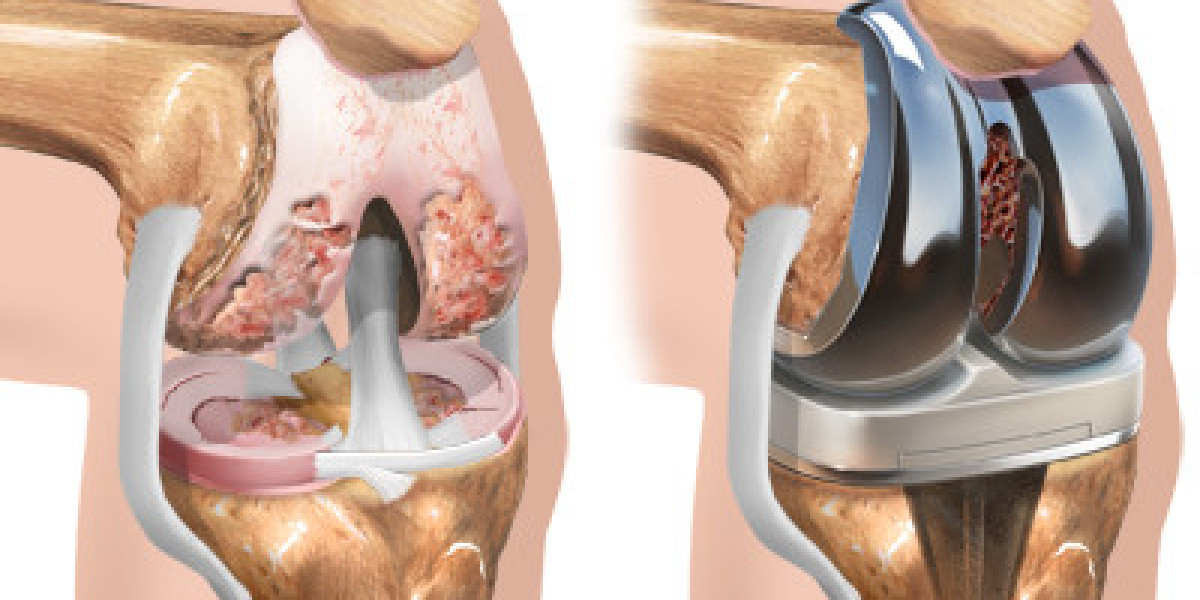 Affordable Knee Arthroscopy Surgery in Jaipur – Consult Dr. Abhishek Gupta