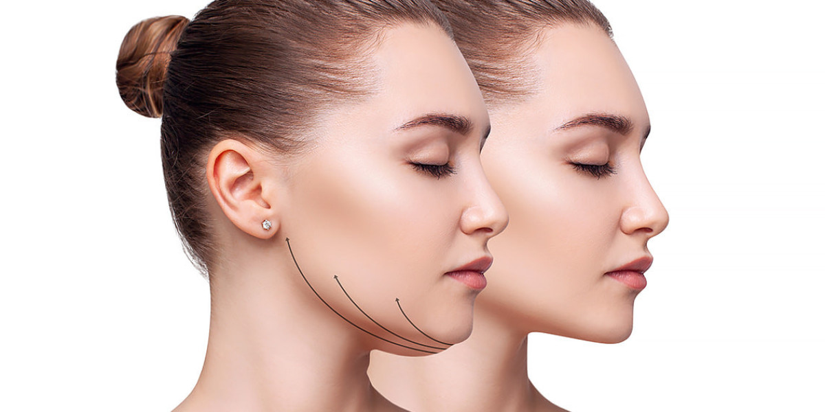 Wie lange wirkt die Fett Weg Spritze? Haltbarkeit und Ergebnisse erklärt