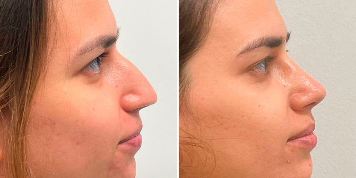 Nasenkorrektur Zürich: Alles, was Sie wissen müssen