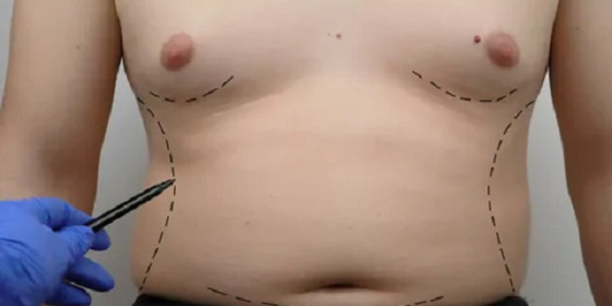 Gynaecomastia surgery in Dubai: Top-Tier Male Procedures